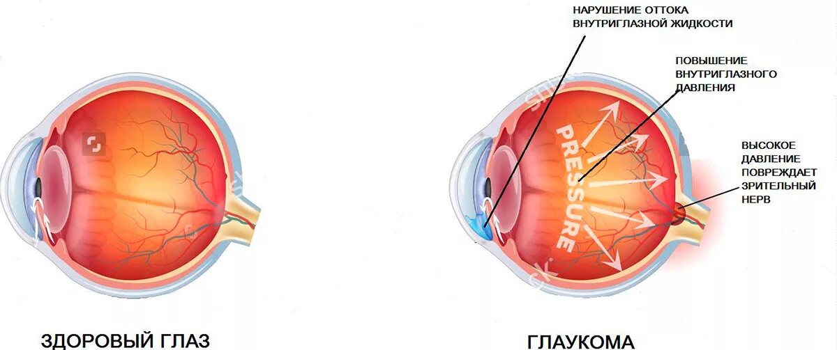 Здоровые глаза. Профилактика слепоты от глаукомы. Как выглядит здоровый глаз.