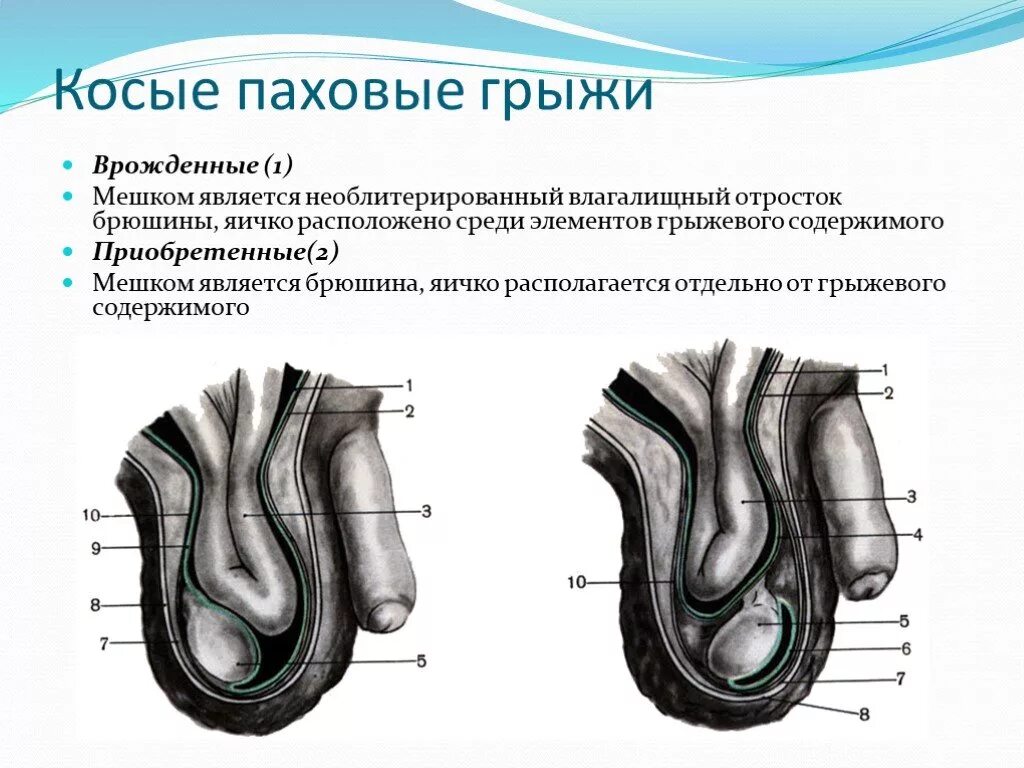 Врожденная паховая мошоночная грыжа. Канатиковая паховая грыжа. Косая приобретенная паховая грыжа. Врожденная паховая грыжа топографическая анатомия. Прямая и косая паховые грыжи