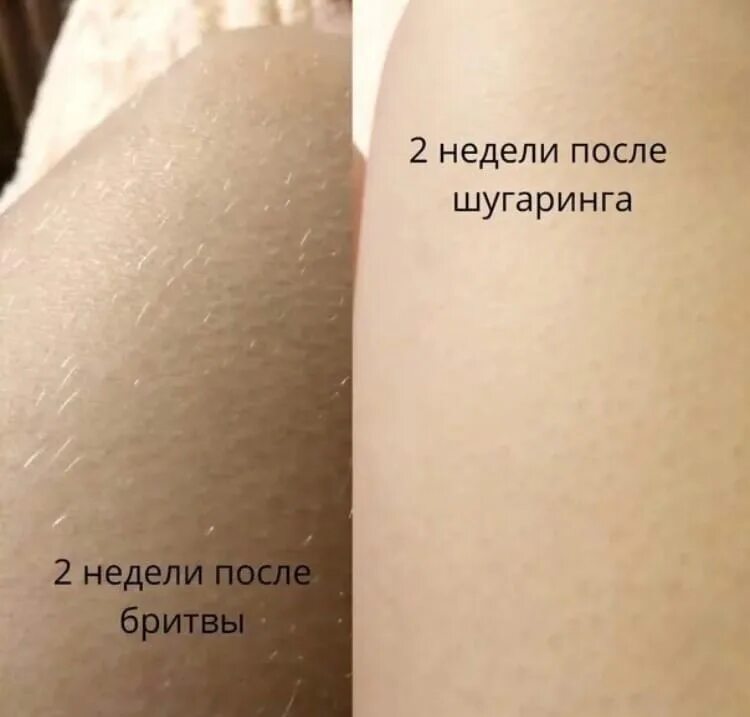 Как растут волосы после шугаринга. Волос после бритвы и после шугаринга. волосы на ногах после бритвы.