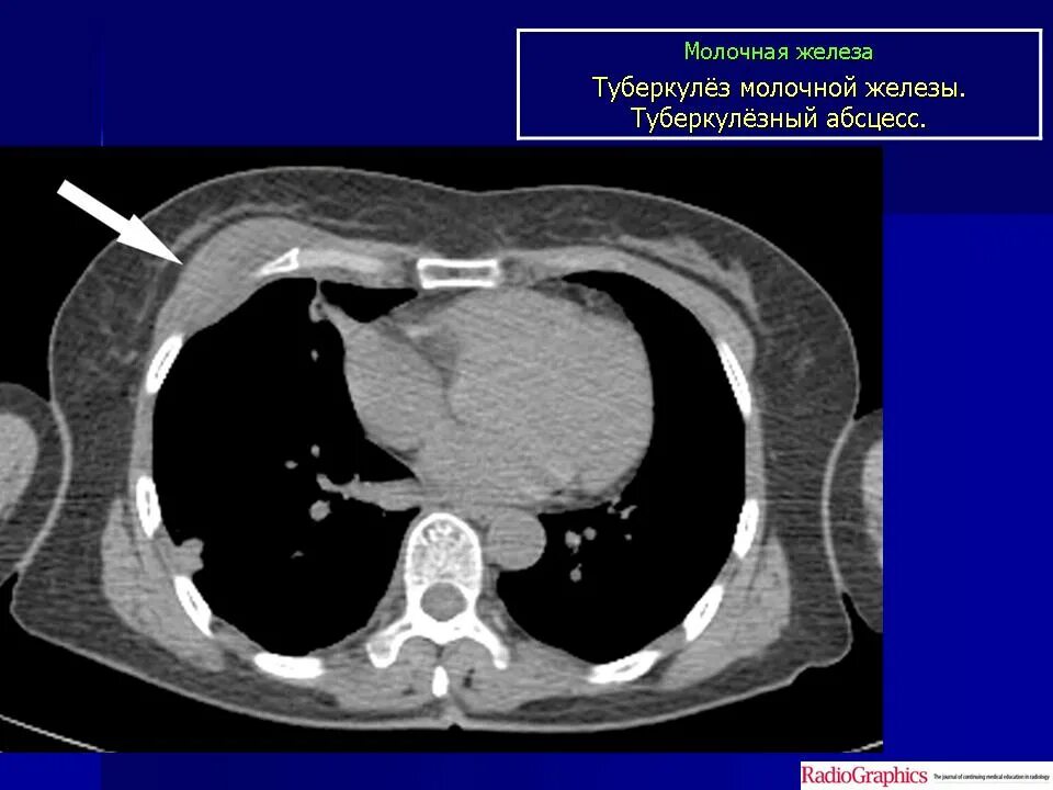 Туберкулез молочной. Туберкулез молочной железы. УЗИ диагностика туберкулеза молочной железы. Туберкулез молочной железы фото. Туберкулёз молочной железы на УЗИ фото.