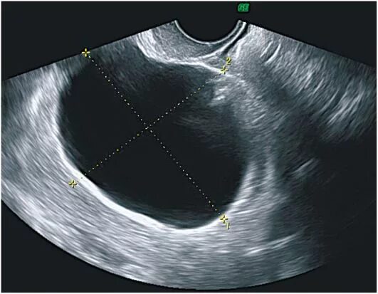 Low grade яичников. Цистаденонома яичника УЗИ. Серозная цистаденома яичника на УЗИ. Муцинозная киста яичника на УЗИ.