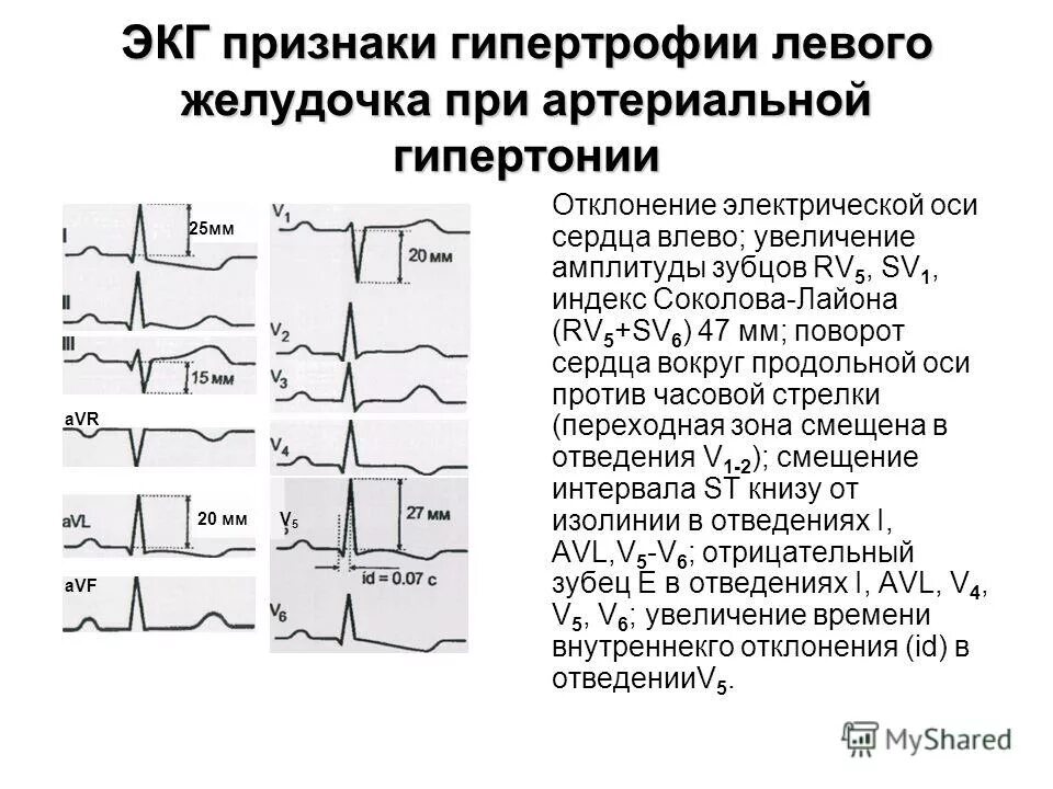 Экг при гипертрофии правого желудочка. Признаки гипертрофии миокарда на экг. Экг критерий при гипертрофии левого желудочка. Левожелудочковая гипертрофия. Что такое признаки глж.