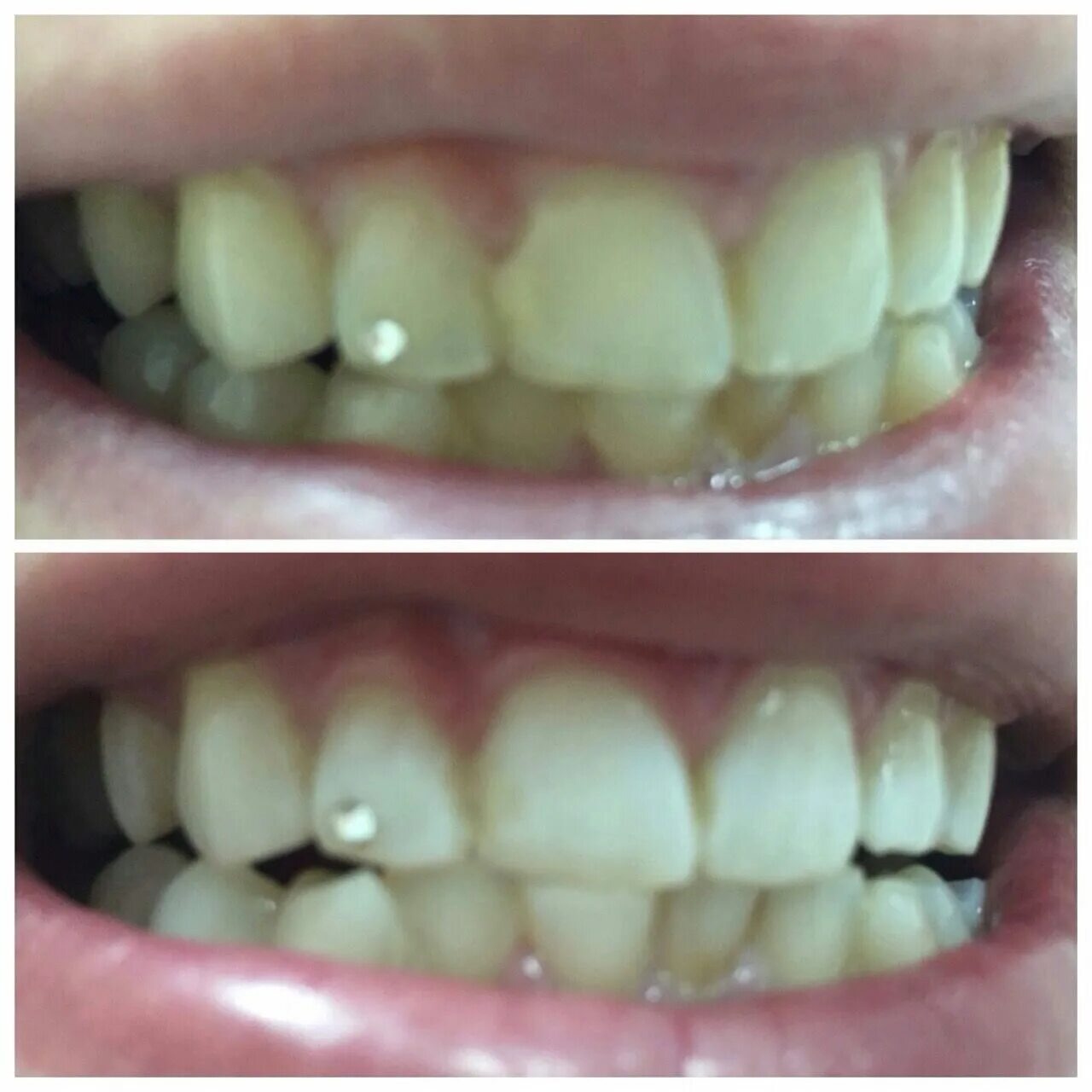 Внутреннее отбеливание зубов. Отбеливание зубов с пломбами. Внутрикоронковая полимерная шина. Можно отбелить зубы с пломбами. Внутрикоронковое отбеливание зубов.