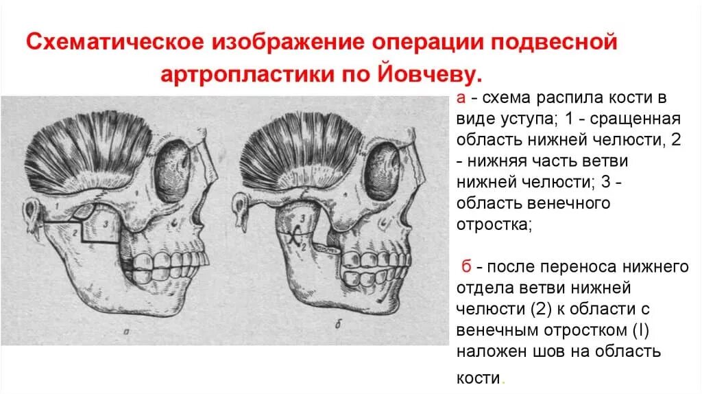 Лечение сустава нижней челюсти. Синовиальная оболочка внчс. Артрит, артроз, дисфункция височно-челюстного сустава. Лечение сустава нижней челюсти. Височно - нижнечелюстной артрит классификация.