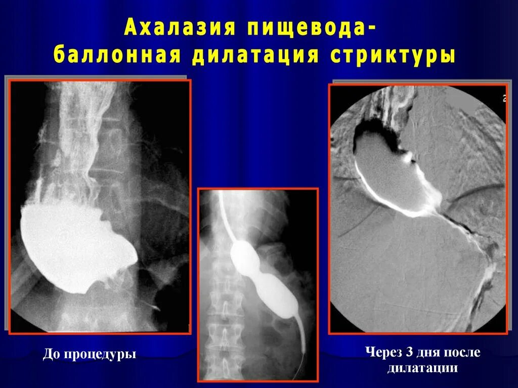 Ахалазия пищевода лучевая диагностика. Баллонная дилатация стриктуры пищевода. Ахалазия пищевода рентген. Халазия пищевода