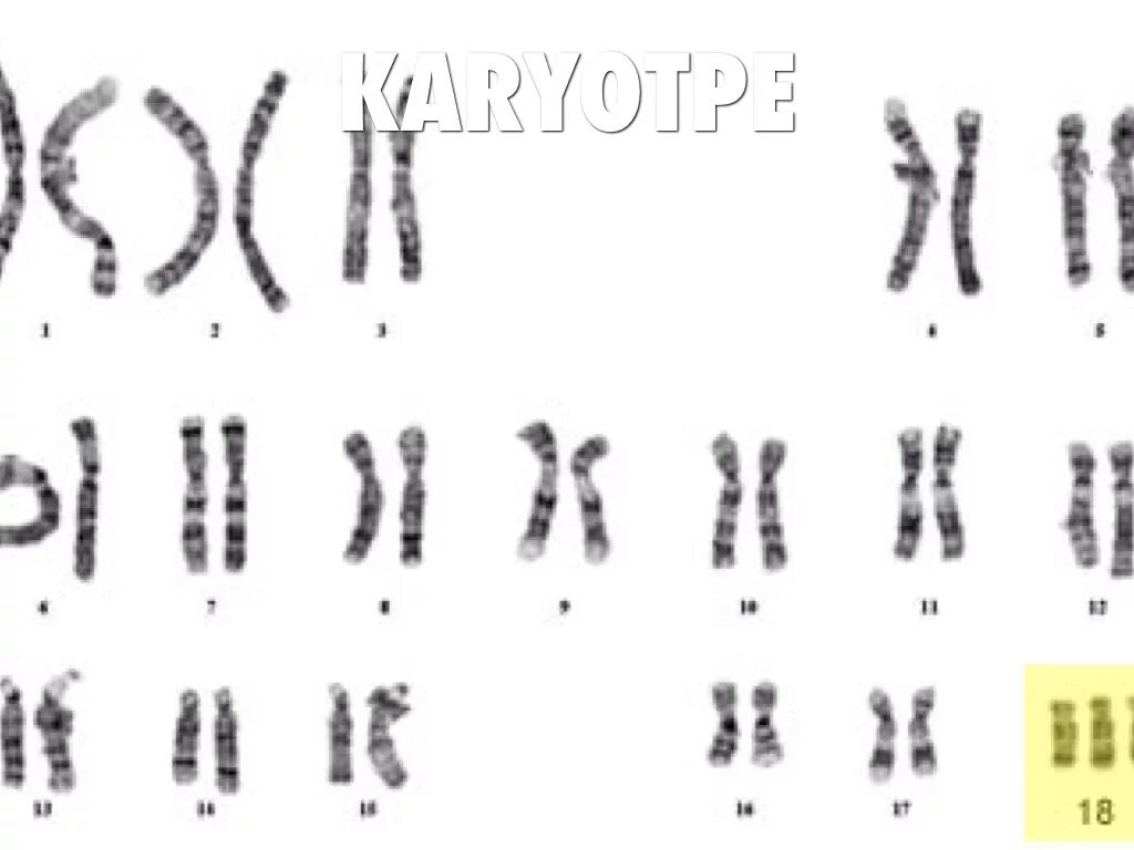 Водоросли хромосомы. Трисомия 18 хромосомы кариотип. Синдром Эдвардса (трисомия 18 хромосомы) -. Кариограмма синдрома Эдвардса. Кариотип человека с синдромом Эдвардса.