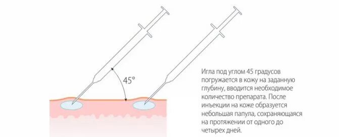 Техника введения иглы при биоревитализации. Линейно ретроградная техника введения биоревитализанта схема. Мезотерапия техники введения схема. Схема глубины инъекций мезотерапии..