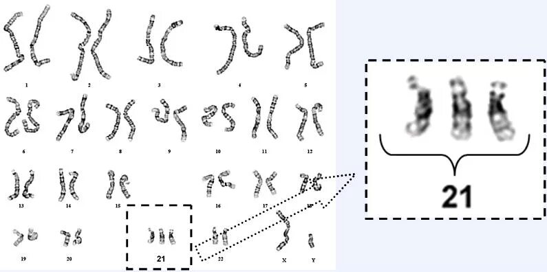 Синдром Дауна 21 хромосома. Синдром Дауна трисомия 21 хромосомы. Синдром Дауна схема хромосом. Синдром Дауна лишняя хромосома. Лишняя 21 хромосома