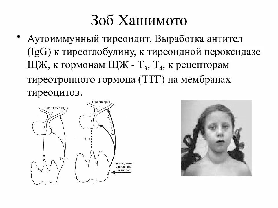 Зоб тиреоидит