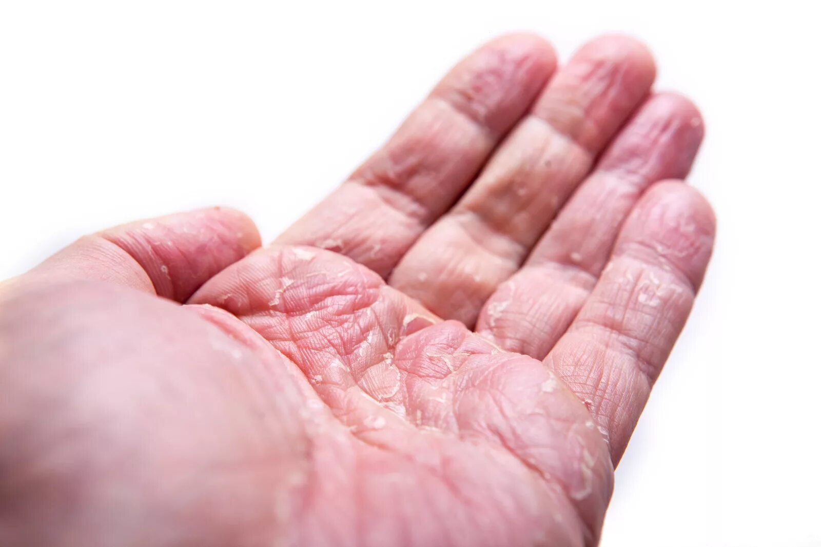 Почему руки розовые. Экзема лихенизированная. Дисгидротическая экзема (аллергический дерматит).. Тилотическая экзема кистей.