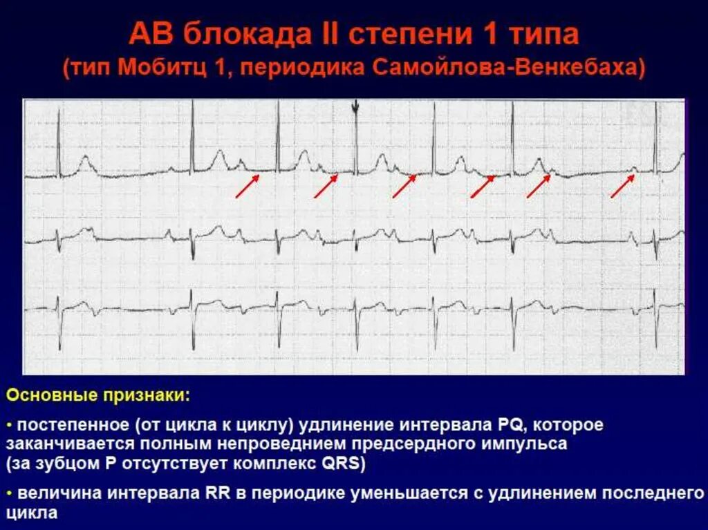 Блокада заболевание. Периоды Самойлова Венкебаха. ЭКГ внутрипредсердная блокада av блокада 2 степени. AВ блокады 2 степени с периодами Самойлова Венкебаха. АВ блокады сердца на ЭКГ.