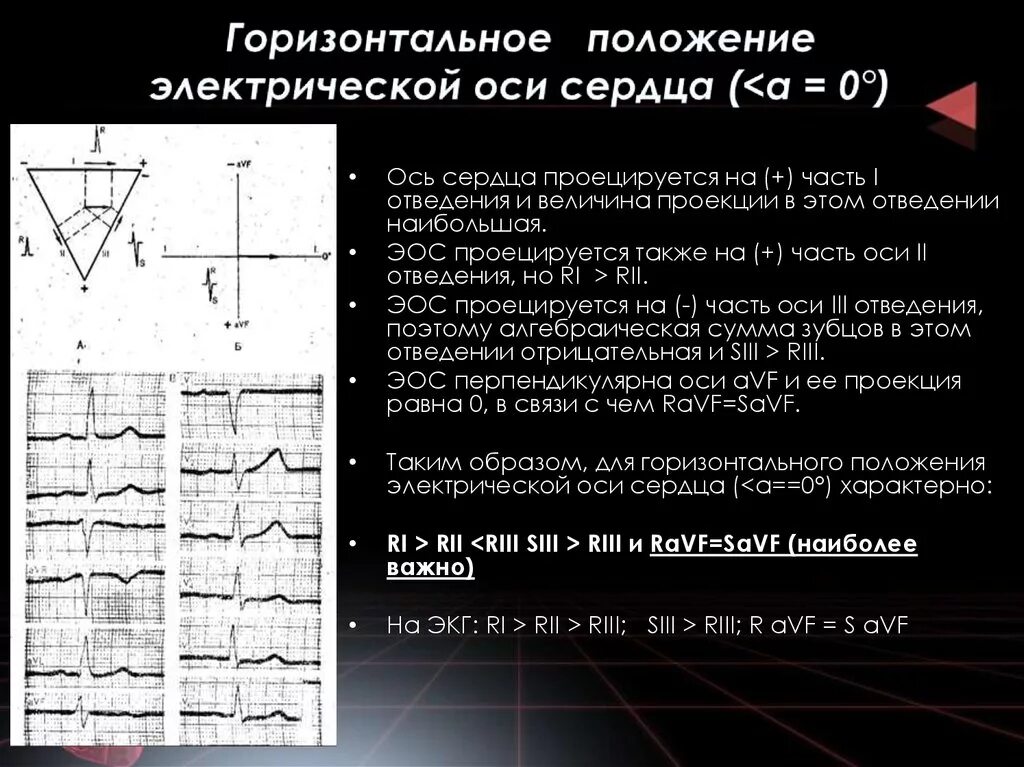 Вертикальная позиция сердца. Горизонтальное направление электрической оси на ЭКГ. ЭКГ оси вертикальная и горизонтальная. Горизонтальная ось сердца на ЭКГ. Горизонтальное положение ЭОС на ЭКГ.