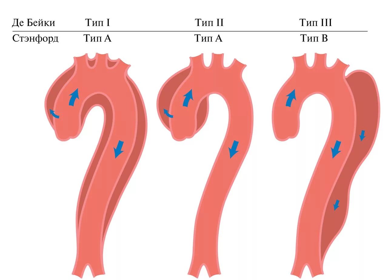 Расслоение аорты классификация. Типы аневризмы аорты. Типы аневризмы аорты. Классификация аневризм брюшного отдела аорты. Типы аневризм брюшной аорты классификация.