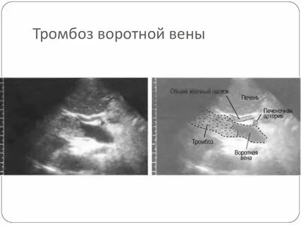 Тромбоз воротных вен
