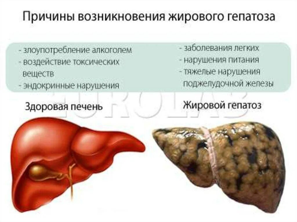 Признаки гепатомегалии жирового