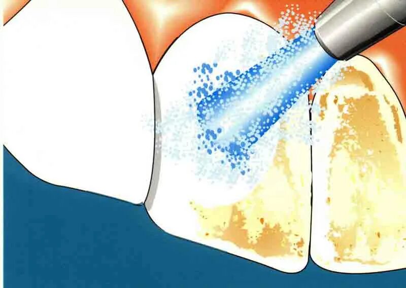 Снятие зубного налета Air Flow. Метод чистки зубов Эйр Флов. Проф. чистка(снятие зубного камня, удалениеналёта) (1 ед.). Смолу использовали для чистки зубов