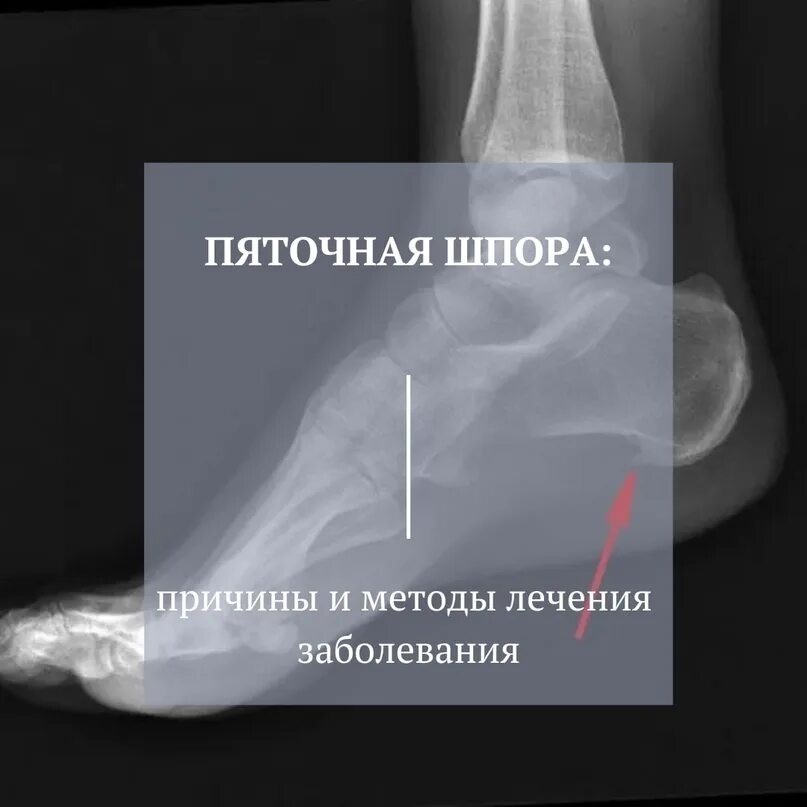 Почему появляется шпора причины. Пяточная шпора причины. пяточная шпора на снимке. пяточная шпора причины возникновения.