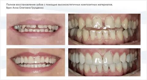 Реставрация композитными материалами