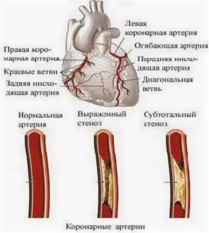 Процент стеноза сосудов. Стеноз коронарных артерий. Степени стеноза коронарных артерий. Степень сужения венечных артерий. Степени сужения коронарных артерий.