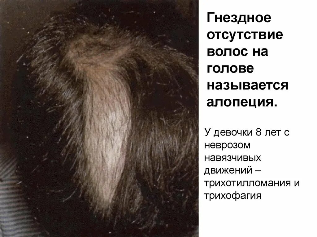 Презентация на тему алопеция. Алопеция лихенификация. Анагеновая диффузная алопеция. Диффузная сифилитическая алопеция. Гнездная алопеция клинические рекомендации.