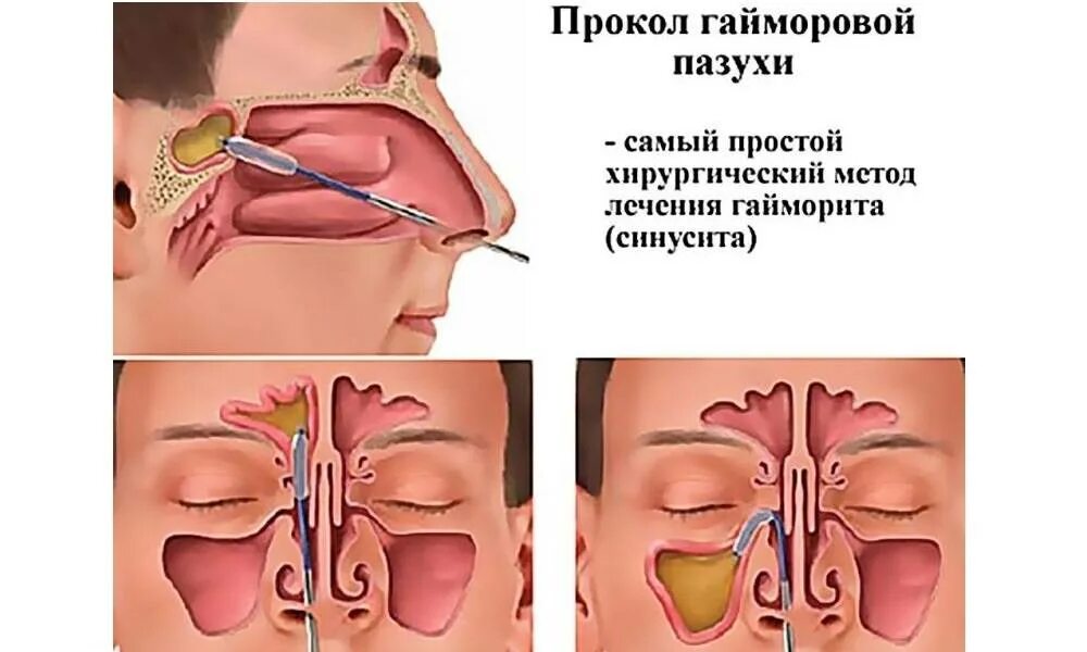 Прокол гайморита у взрослых