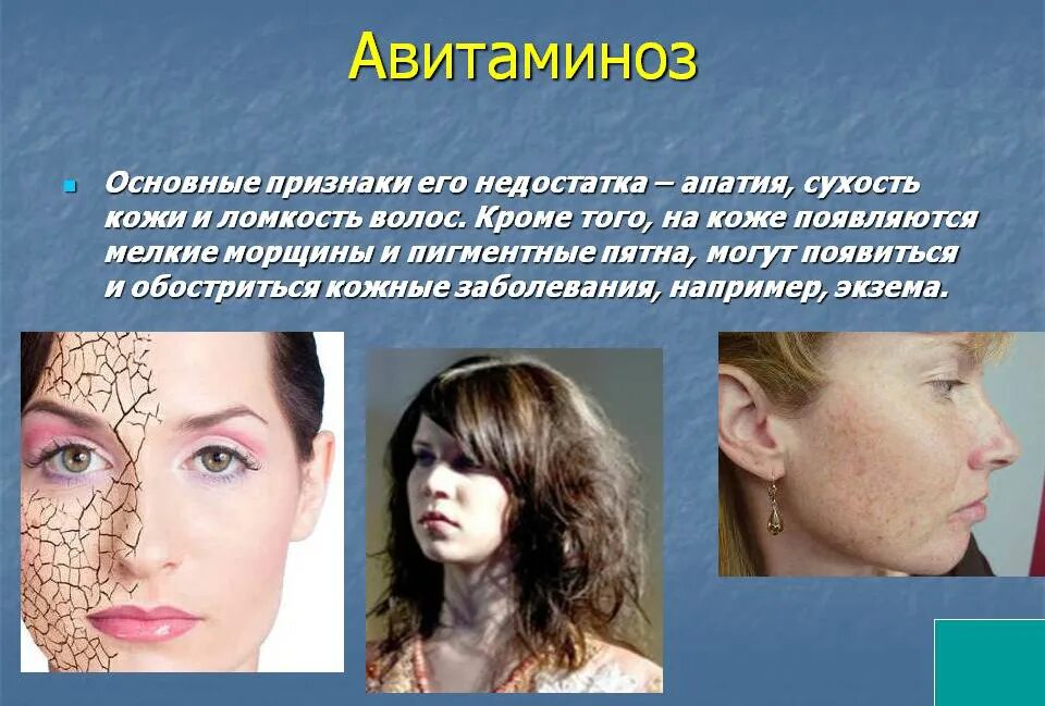 Сушится кожа каких витаминов не хватает. Какие витамины нехвотают. Дефицит витамина а сухая кожа. Каких витаминов не хватает. Список витаминов полезных для кожи.