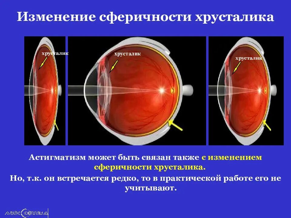 Миопия астигматизм глаз. Остег астигматизм. Сложный миопический астигматизм. Астигматизм хрусталика. Астигматизм презентация офтальмология.