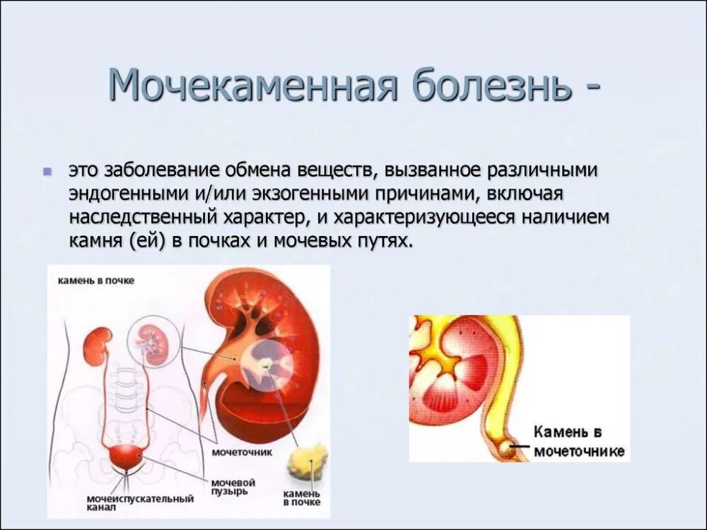 Болезни мочу мужчин. Заболевания мочевыделительной системы мочекаменная болезнь. Заболевание почек мочекаменная болезнь симптомы. Мочекаменная болезнь (urolithiasis). Моче-КАМНЕННАЯ болезнь.