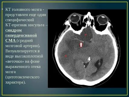 Пневмоцефалия
