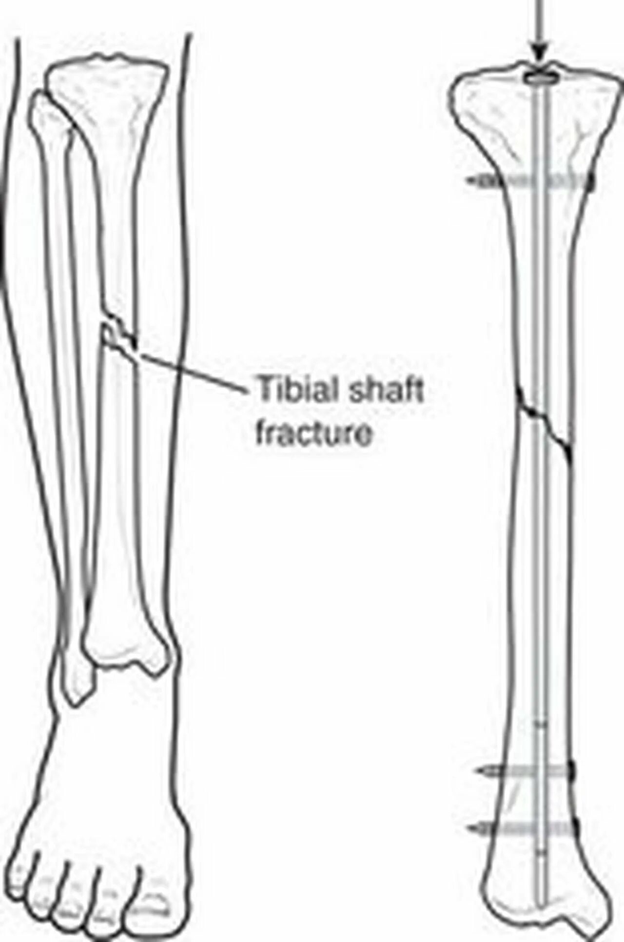 Перелом большеберцовой кости остеосинтез. Интрамедуллярный остеосинтез перелом большеберцовой кости. Остеосинтез перелома берцовой кости. Биос остеосинтез большеберцовой кости. Операция малоберцовой кости
