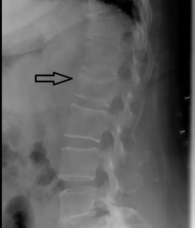 Перелом 12 грудного позвонка рентген. Компрессионный перелом позвоночника л1. Перелом с7 позвонка рентген. Компрессионный перелом позвоночника тн3.
