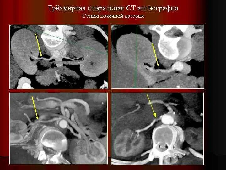 Стеноз артерии почки. Стеноз почечной артерии кт. фибромускулярный стеноз почечной артерии. фибромускулярная дисплазия артерии. фибромускулярная дисплазия.