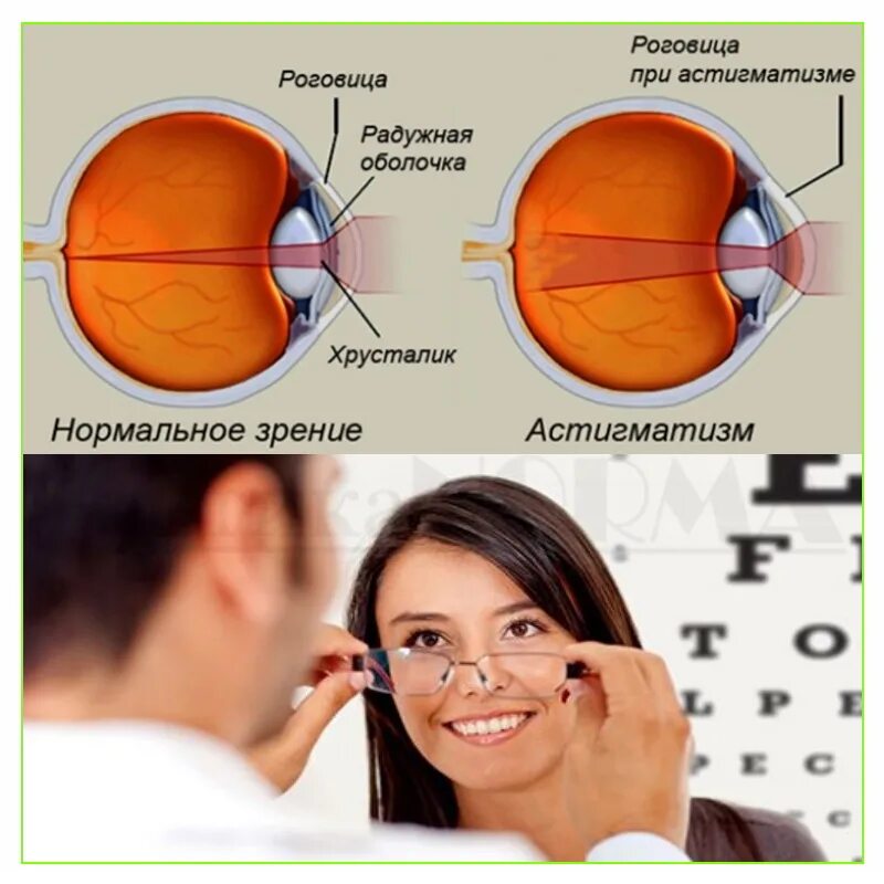 Улучшение зрения при астигматизме. Улучшение зрения при астигматизме