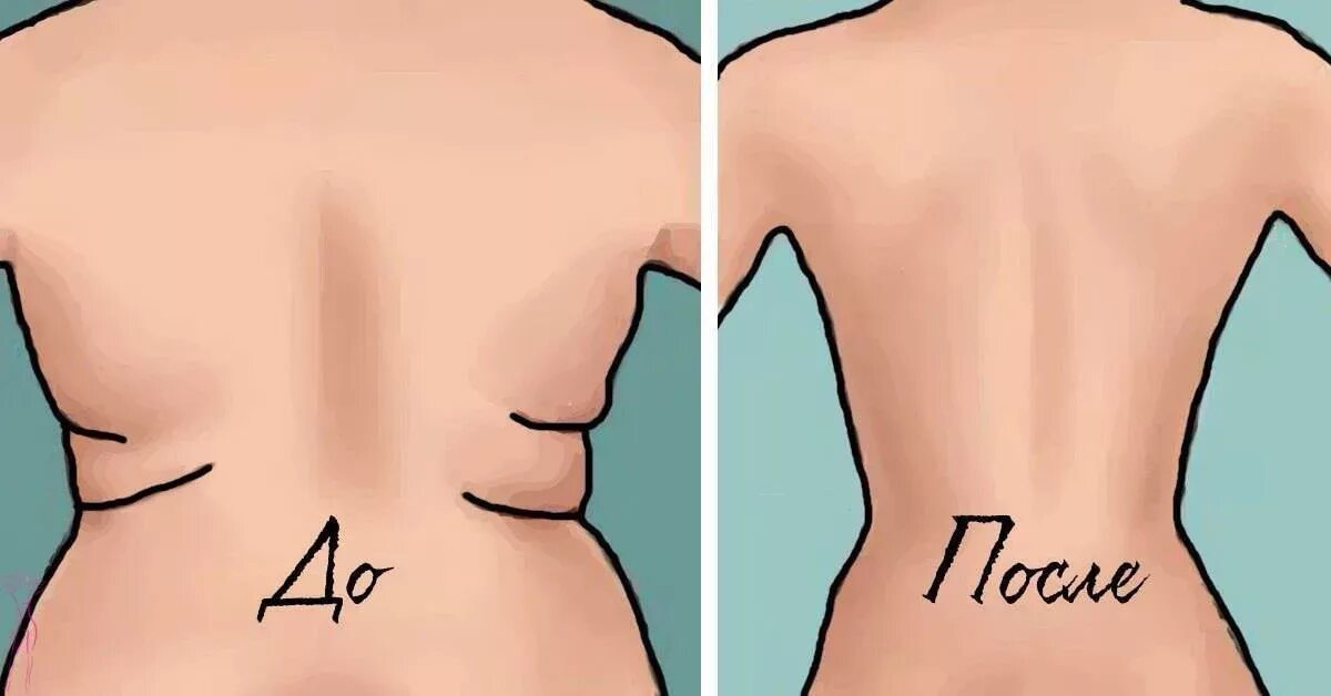 Жировая складка на пояснице. Асимметричность складок на спине. Складки на боках. Back fat