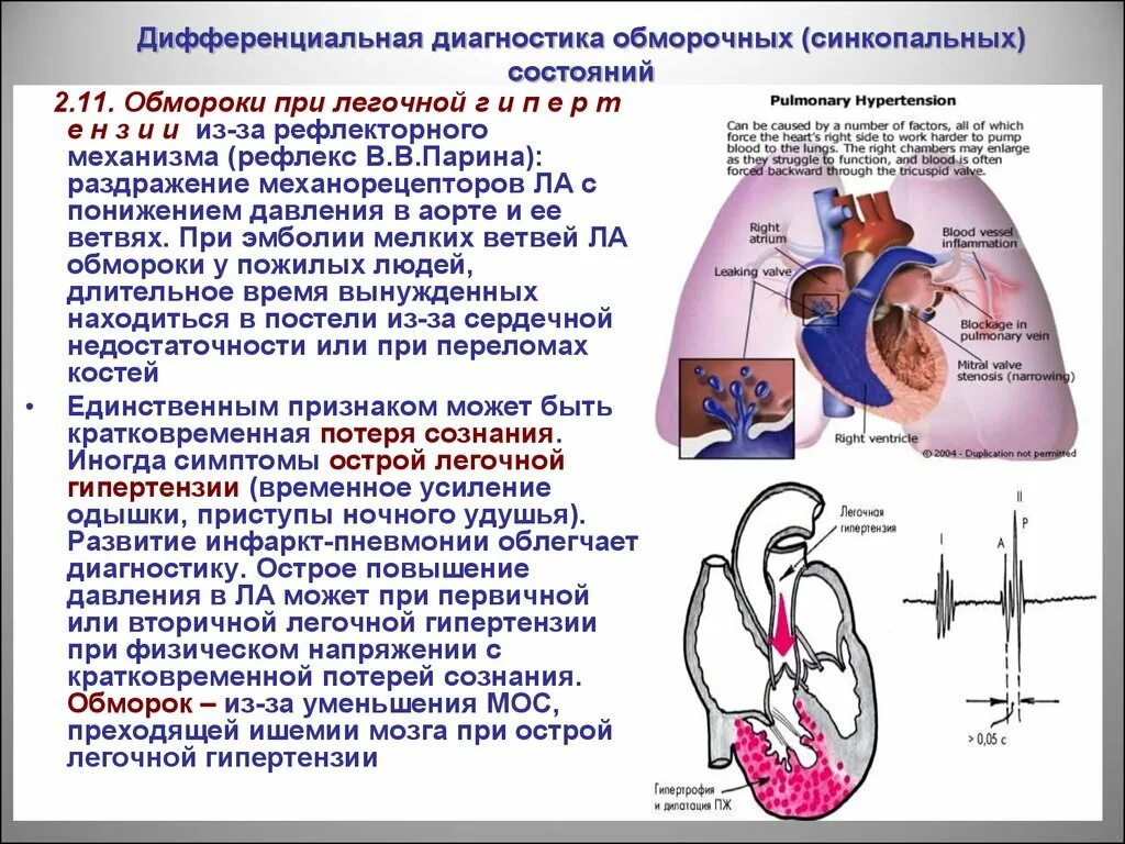 Операция гипертония. Дифференциальный диагноз легочной гипертензии. Дифференциальная диагностика при легочной гипертензии. Дифференциальная диагностика синкопальных состояний (обморока). Дифференциальный диагноз синкопальных состояний.