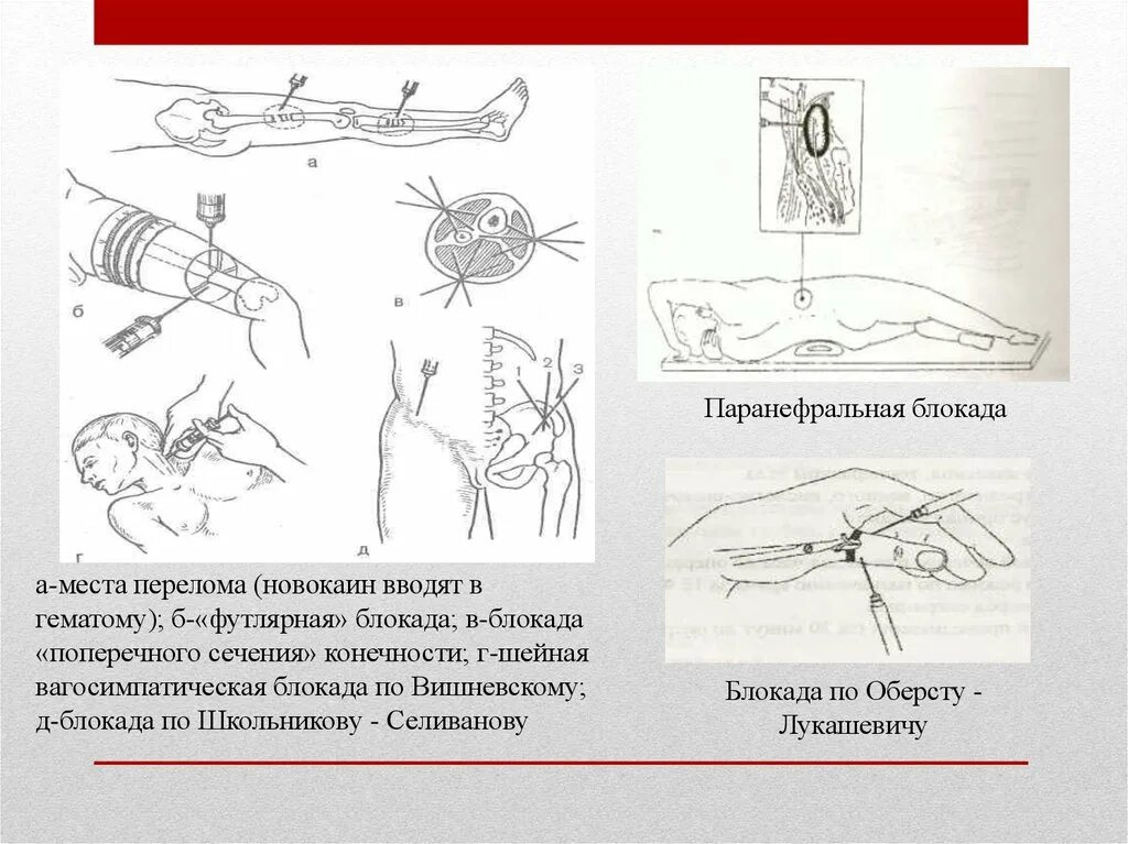 Паранефральная блокада по Вишневскому. Методика проведения паранефральной блокады. Новокаиновая блокада Вишневского. Схема техники поясничной паранефральной новокаиновой блокады. Школьникова селиванова
