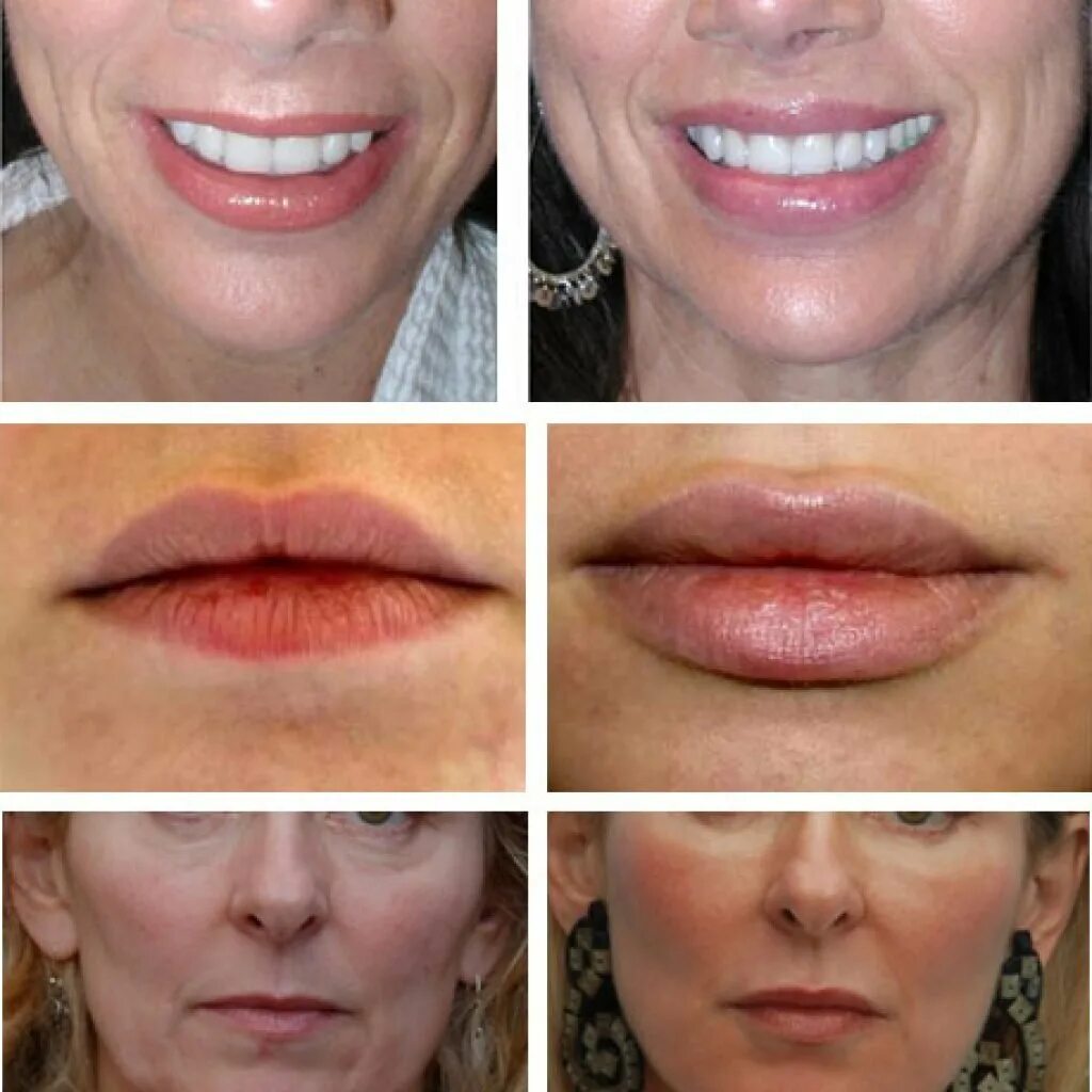 Безопасное увеличение губ с помощью липофилинга. Cosmetic clinic, Clinic