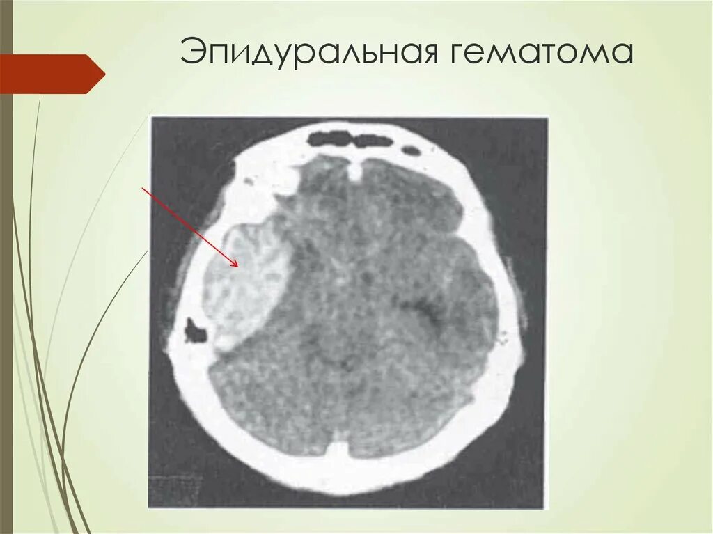 Эпидуральная гематома на кт. Субдуральная и эпидуральная гематома кт. Субдуральная гематома Трепанация. Эпидуральное кровоизлияние кт. Гематома в стадии организации