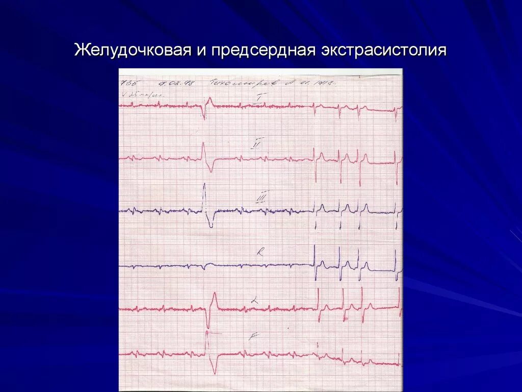 Предсердная экстрасистолия на ЭКГ. Желудочковая экстрасистолия на ЭКГ. Предсердные экстрасистолы на ЭКГ. Желудочкова яаритмия ЭУГ. Типы желудочковых экстрасистол