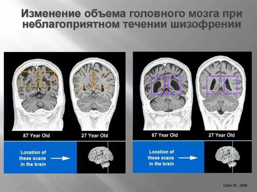 Изменения головного мозга. Снимок головного мозга при шизофрении. Изменения мозга при шизофрении. Изменение ликворокистозного характера