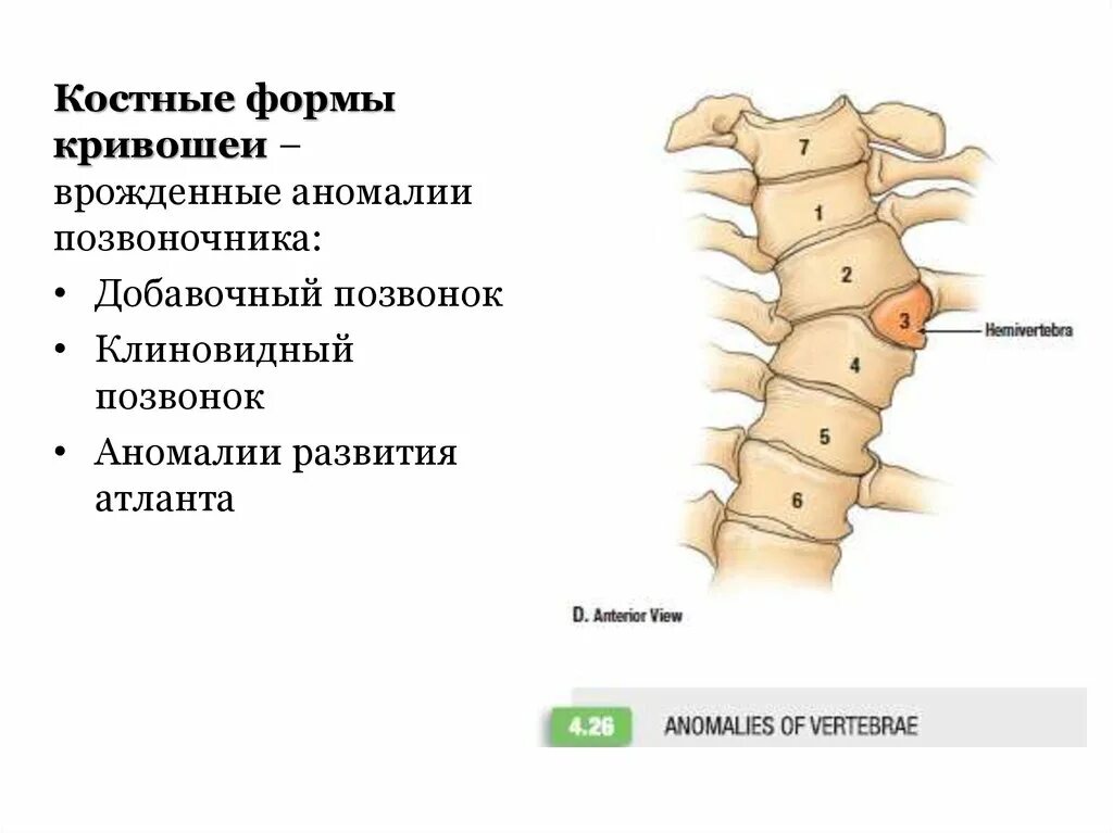 Аномалии развития позвоночника. L3 клиновидный позвонок. Клиновидная деформация шейного позвонка рентген. Аномалия грудного отдела позвоночника клиновидный позвонок. Добавочный клиновидный позвонок.