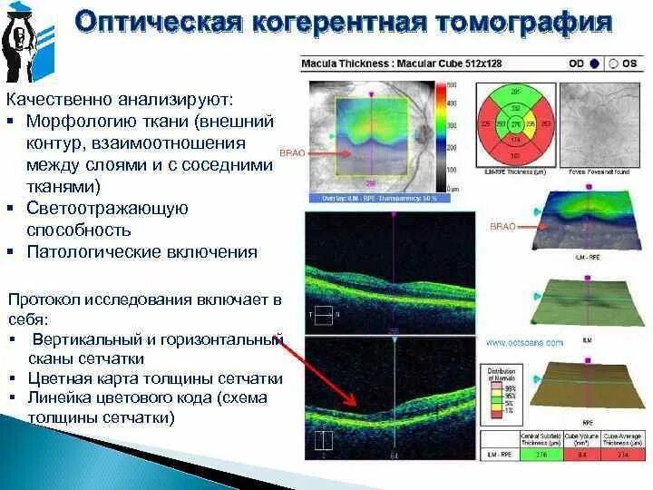 Когерентная томография сетчатки глаза норма. Ост макулы. Окт обеих глаз что это. Оптическая когерентная томография сетчатки (окт). Окт обеих глаз что это.