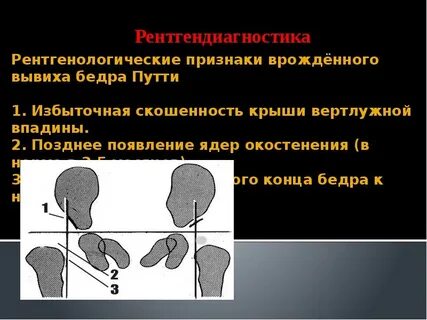 Вывих бедра