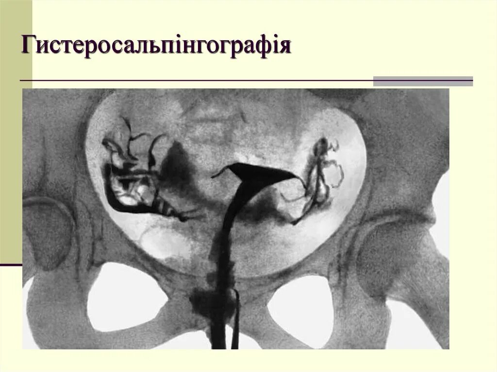 Норма полости матки. Диаметр маточной трубы в норме. Форма матки треугольной формы.