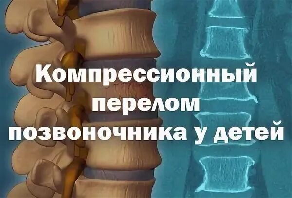 Компрессионный перелом позвоночника th-5-6. Компрессионный перелом позвоночника т9. Компрессионный перелом позвоночника 6-7 позвонков у ребенка. Компрессионный перелом th7.