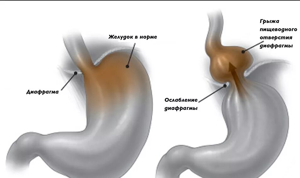 Пролапс желудка в пищевод