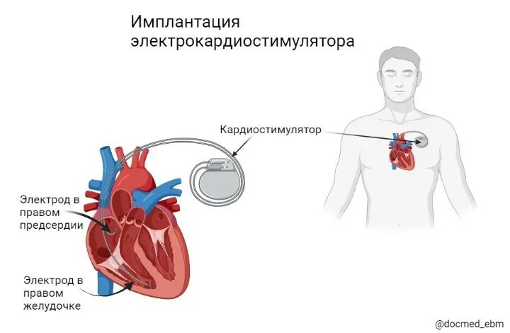 Имплантация кардиостимулятора. Двухкамерный кардиостимулятор. Наружный кардиостимулятор. Однокамерный кардиостимулятор.