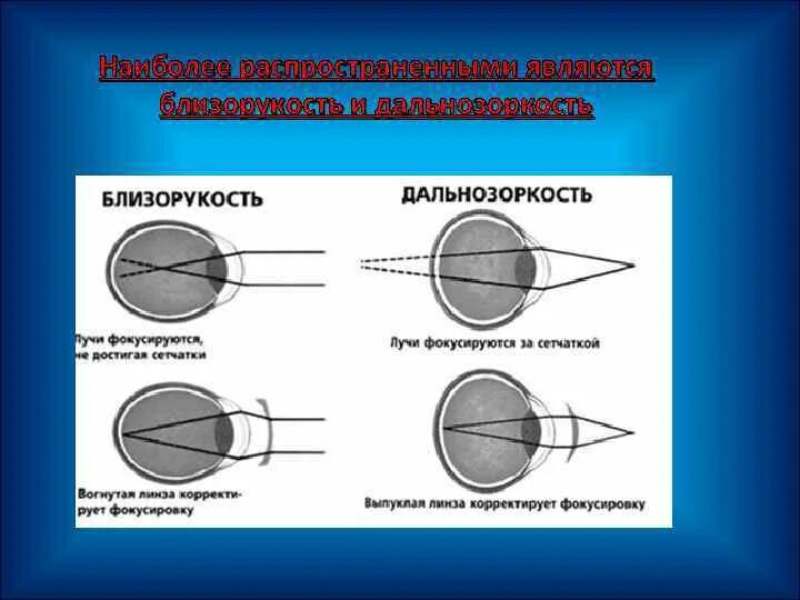 Дополните предложения изображение в близоруком глазу фокусируется