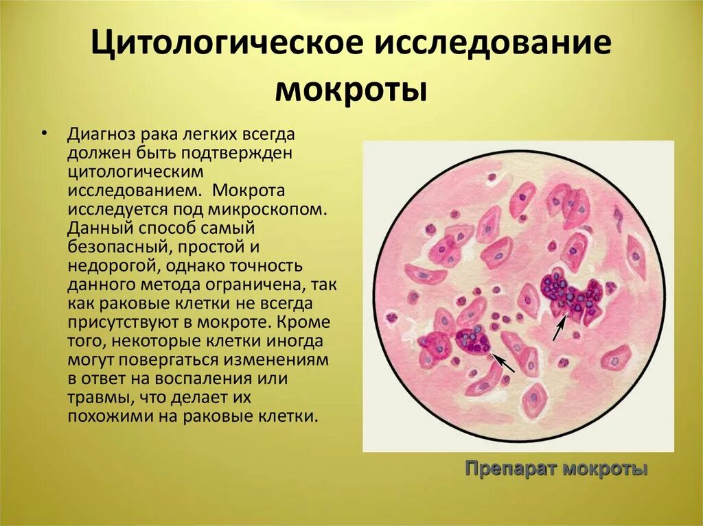 Мокрота всегда. Цитологическое исследование. Цитологическое исследование мокроты. Исследование атипических клеток мокроты. Методы исследования мокроты.