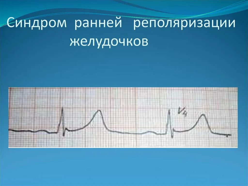 Ранняя реполяризация желудочков сердца на ЭКГ. Ранняя реполяризация желудочков на ЭКГ. Синдром ранней реполяризация желудочков. Синдром ранней деполяризации желу. Нарушение признаков реполяризации